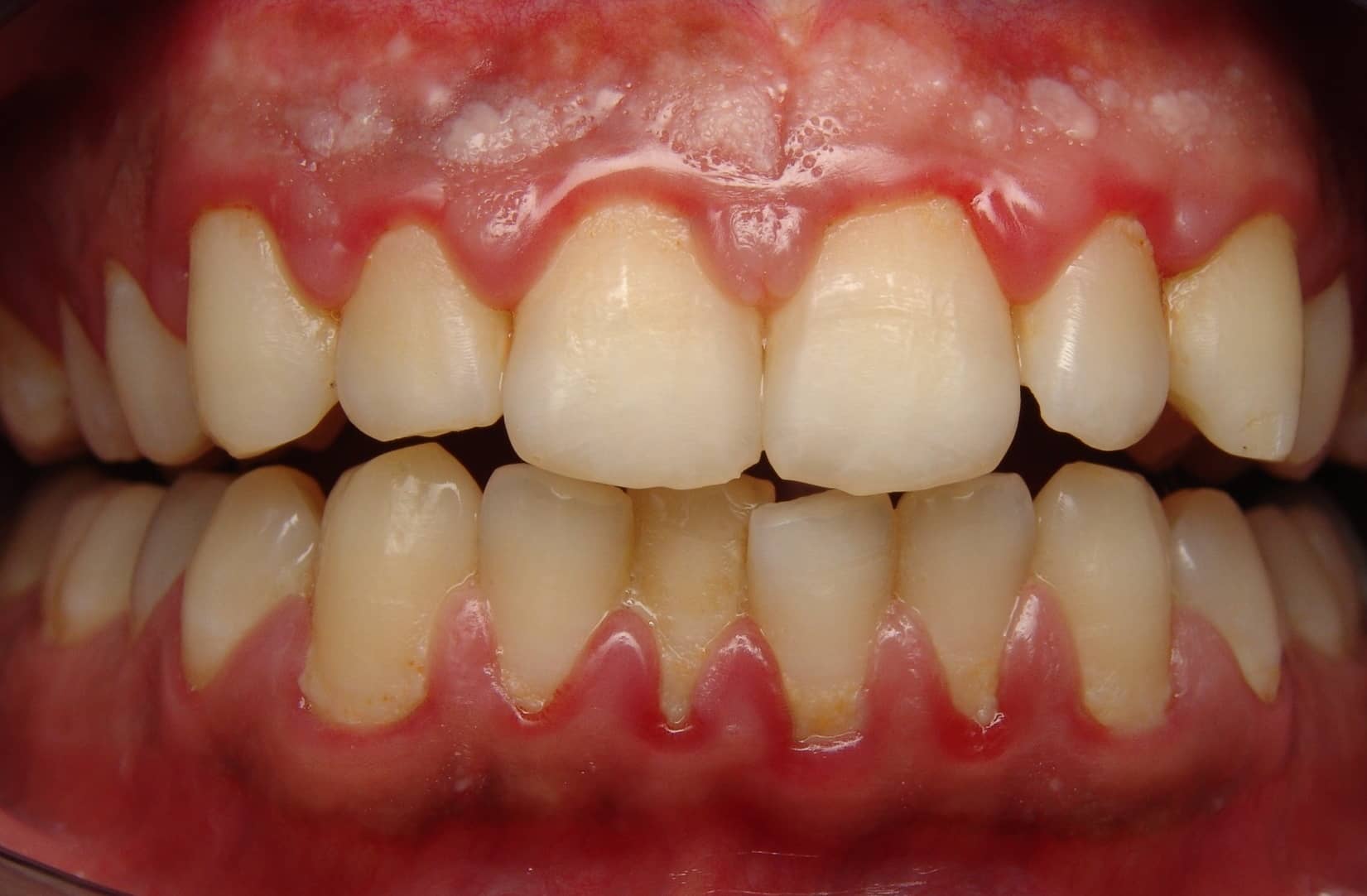 gum-disease-2