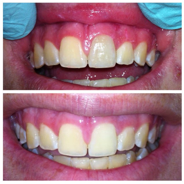 Dental Surgery Results Coverley Dental Barbados Family...