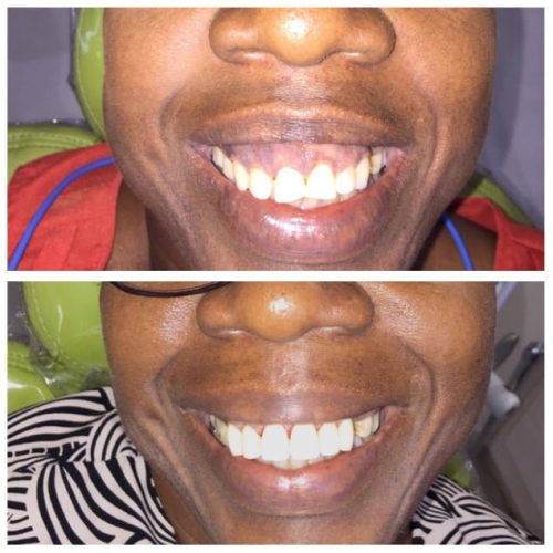 Dental Surgery Results Coverley Dental Barbados Family...