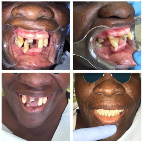 Dental Surgery Results Coverley Dental Barbados Family...