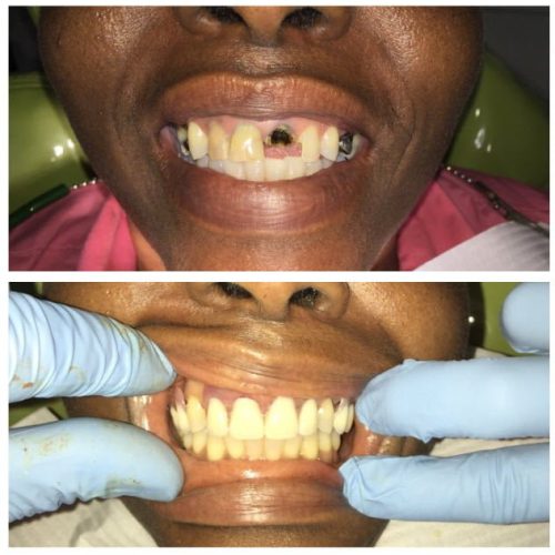 Dental Surgery Results Coverley Dental Barbados Family...