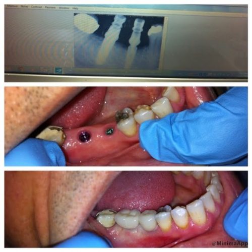 Dental Surgery Results Coverley Dental Barbados Family...